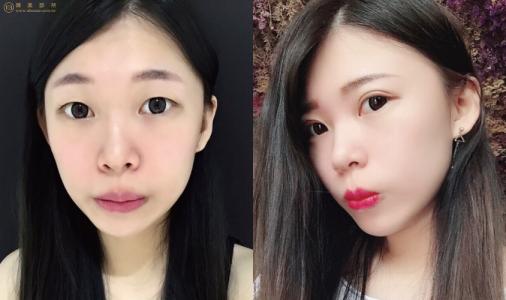 鄭州做雙眼皮的專家有哪些?哪個(gè)醫(yī)生性價(jià)比高?