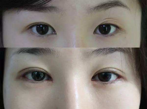 昆明割雙眼皮醫生哪個最好呢？昆明雙眼皮醫生權威推薦