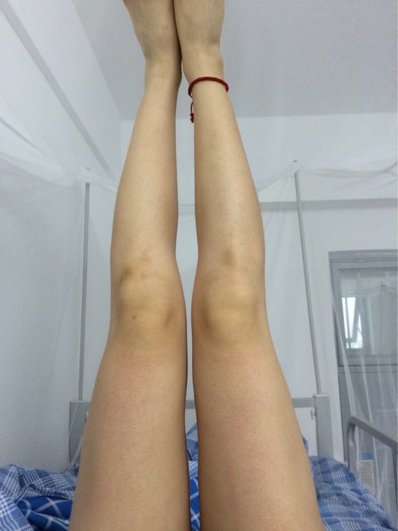 大腿抽脂凹凸不平哪位專家修復好?怎么修復的?