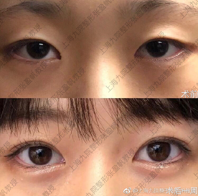 孫盈帆雙眼皮案例