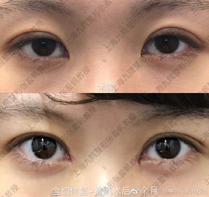 孫盈帆雙眼皮案例