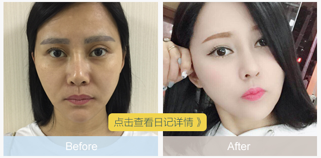 徐曉雯雙眼皮修復案例