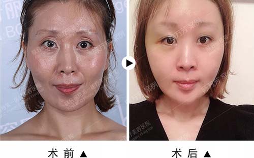 楊大平面部提升案例