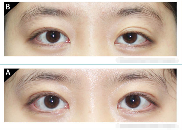 山西太原雙眼皮醫(yī)生技術(shù)好的都有哪些？求推薦！