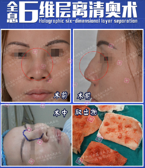 鄧正軍奧美定取出案例