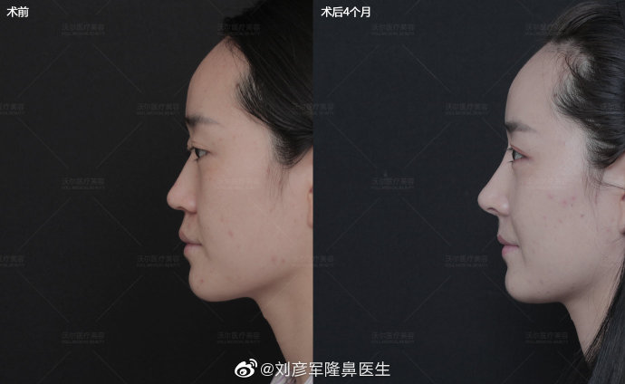 劉彥軍隆鼻案例