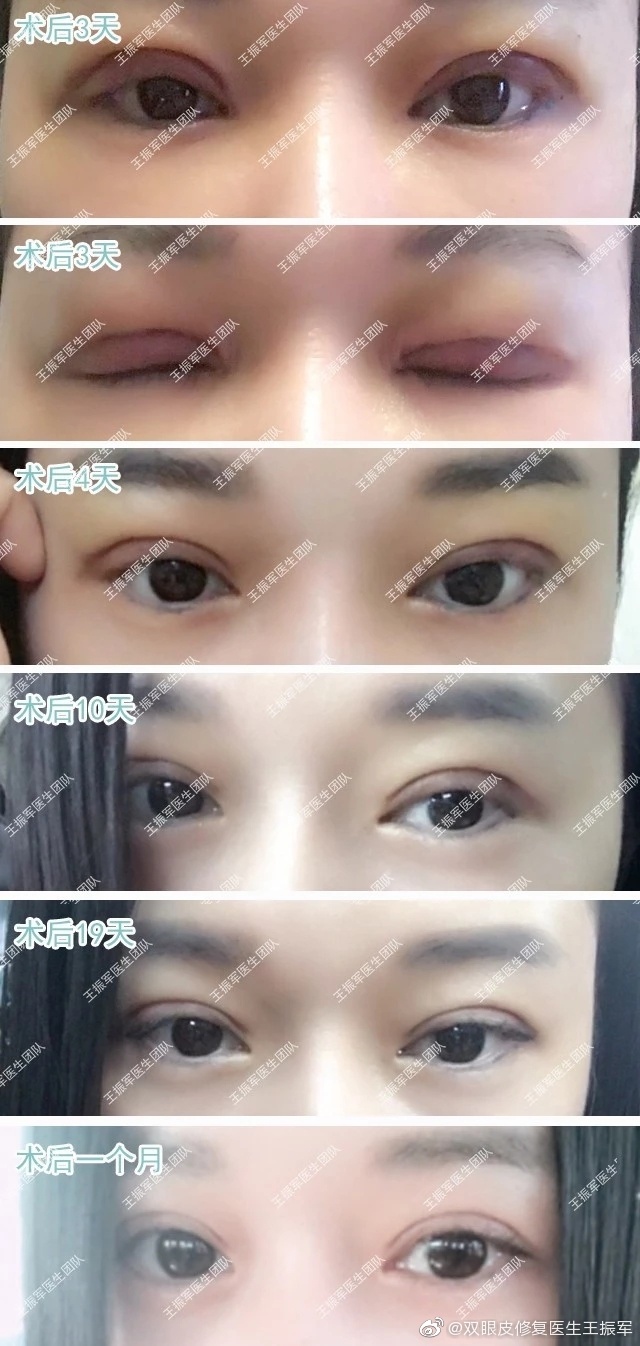 王振軍雙眼皮修復(fù)