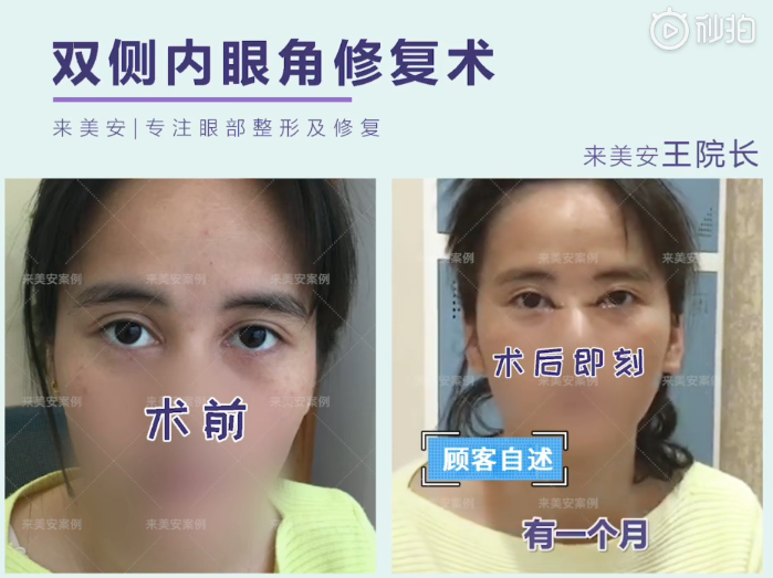 王振軍雙眼皮修復(fù)案例
