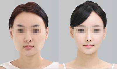 上海磨骨和下頜角哪個做的最好？李志海和何晉龍哪個好？