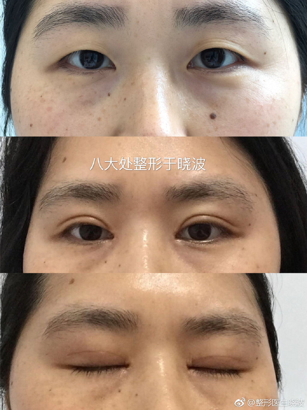于曉波雙眼皮案例