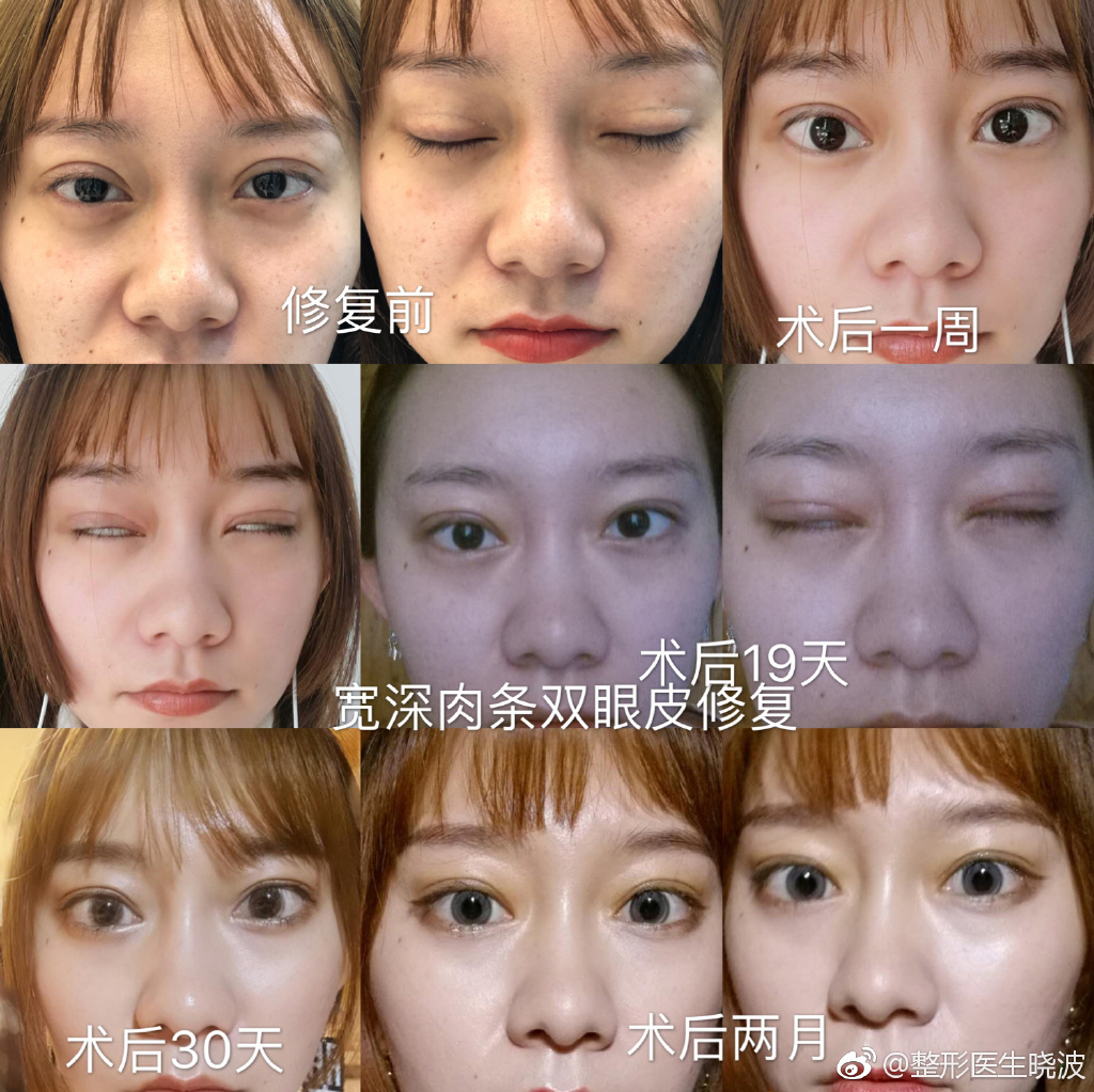 于曉波雙眼皮修復案例
