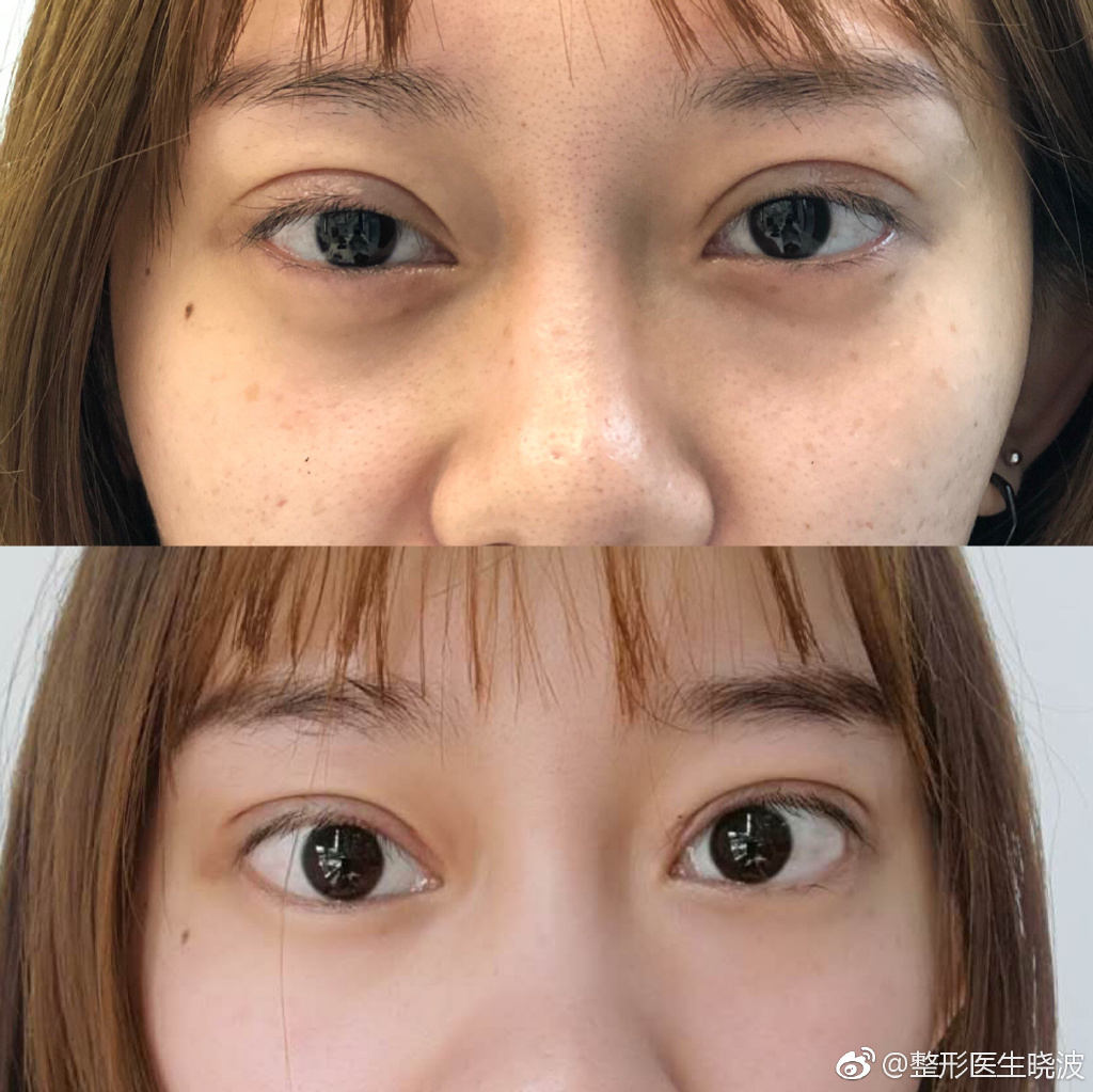 于曉波雙眼皮修復案例