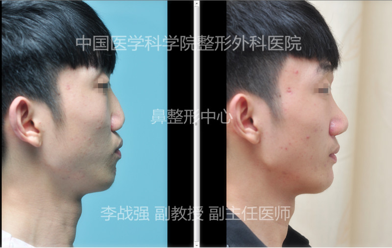 李戰強隆鼻案例