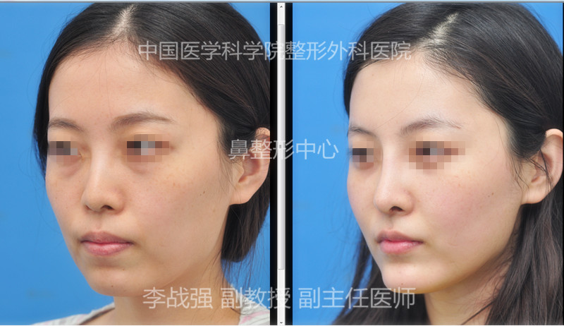 李戰強隆鼻案例