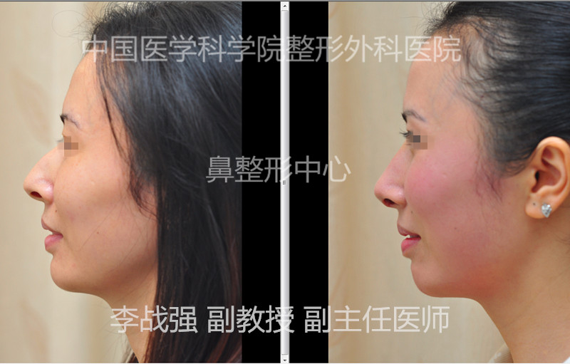 李戰強隆鼻案例