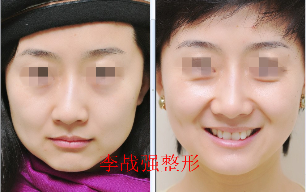 李戰強隆鼻案例