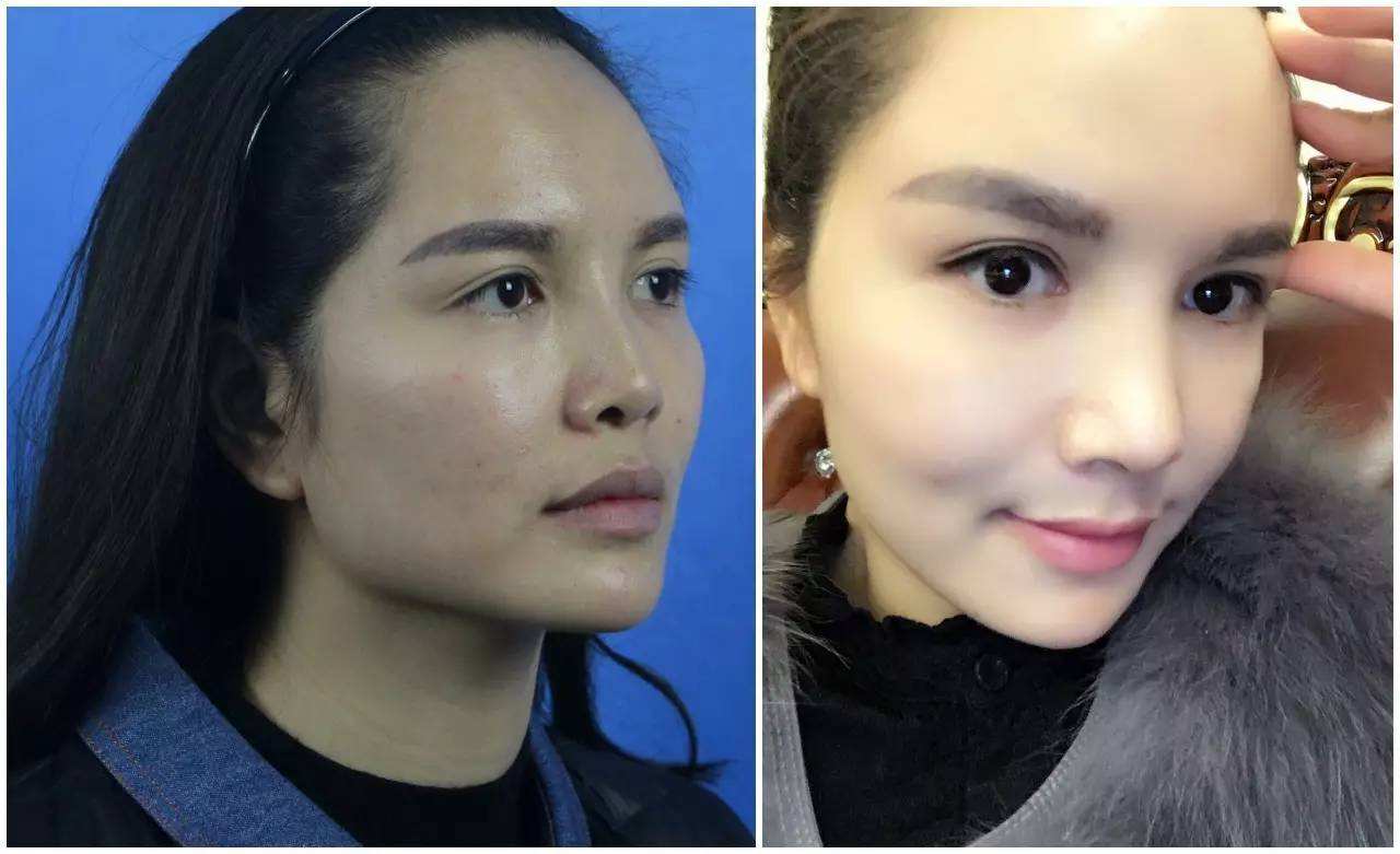 上海隆鼻哪個醫(yī)院和醫(yī)生好？大概需要多少錢？肋骨鼻好嗎？