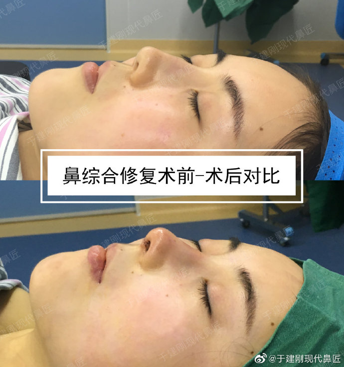 于建剛鼻修復(fù)案例