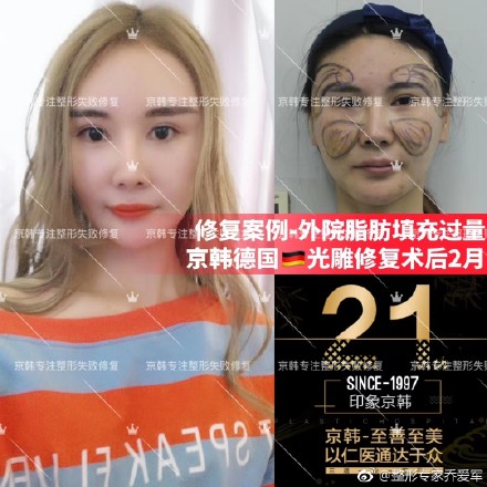 喬愛軍脂肪修復