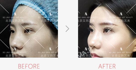 艾瑪脂肪修復