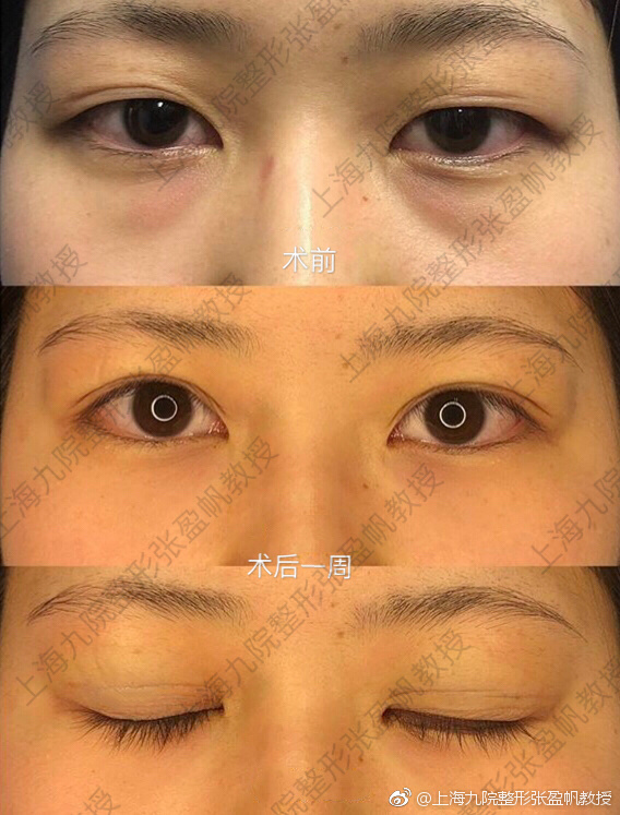 上海九院做眼綜合大概多少錢？哪個醫生最好？