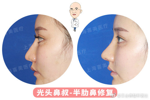 王會(huì)勇鼻修復(fù)案例