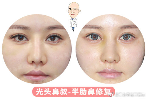 王會(huì)勇鼻修復(fù)案例