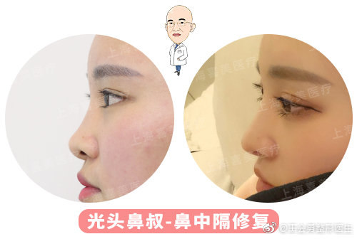 王會(huì)勇鼻修復(fù)案例