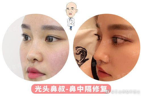 王會(huì)勇鼻修復(fù)案例