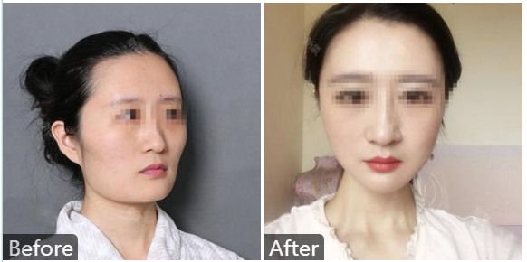 八大處整形磨骨內推多少錢？哪個專家做磨骨好？