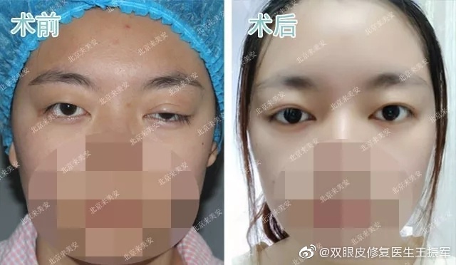 王振軍雙眼皮修復案例