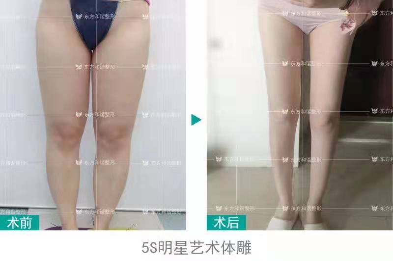 張準(zhǔn)大腿吸脂案例