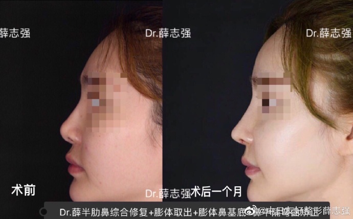 薛志強(qiáng)鼻修復(fù)案例