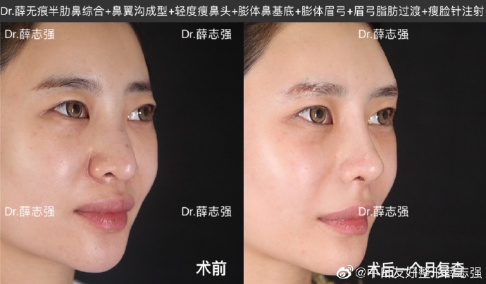薛志強(qiáng)鼻修復(fù)案例