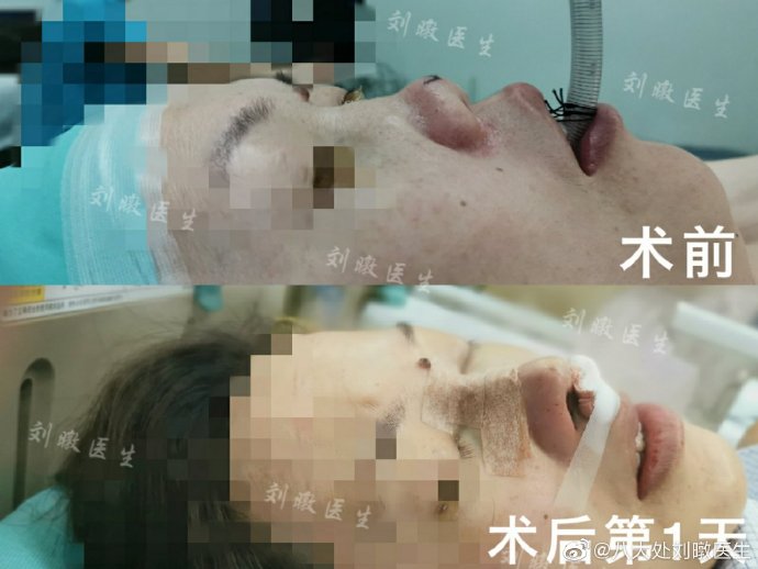 劉暾隆鼻案例