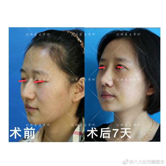 劉暾隆鼻案例