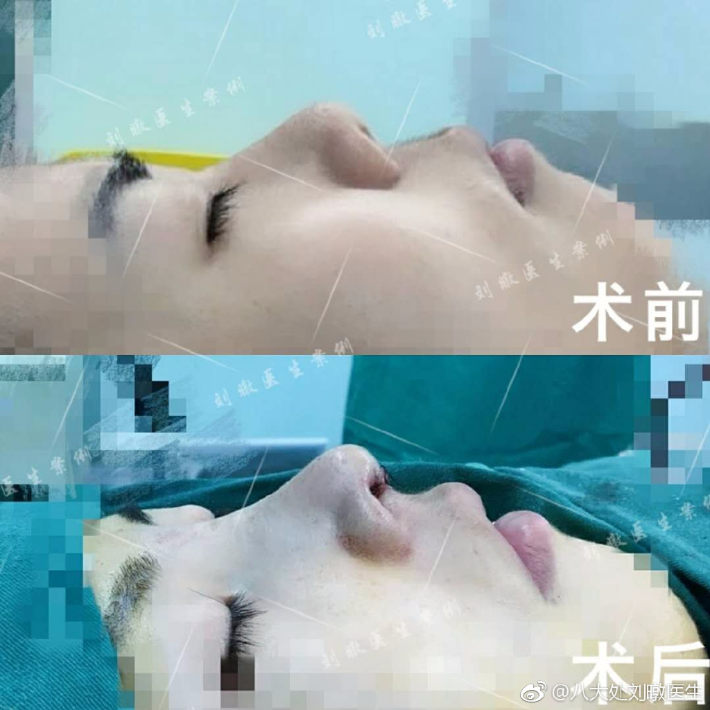 劉暾隆鼻案例