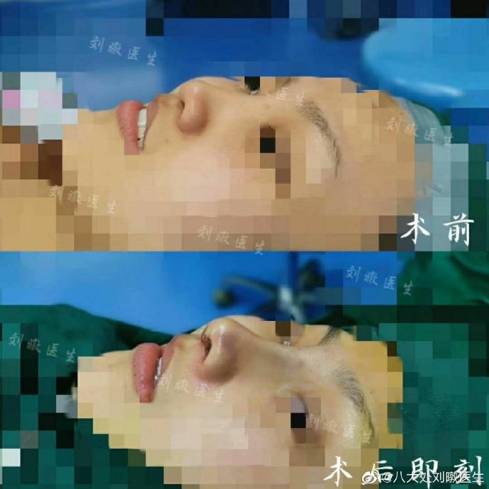 劉暾隆鼻案例
