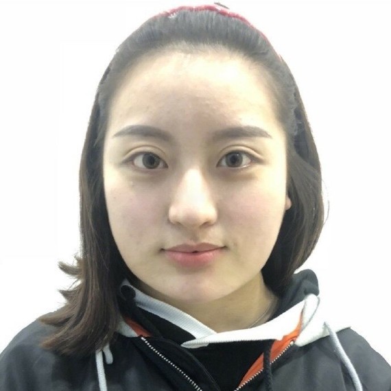 馬桂娥吸脂案例