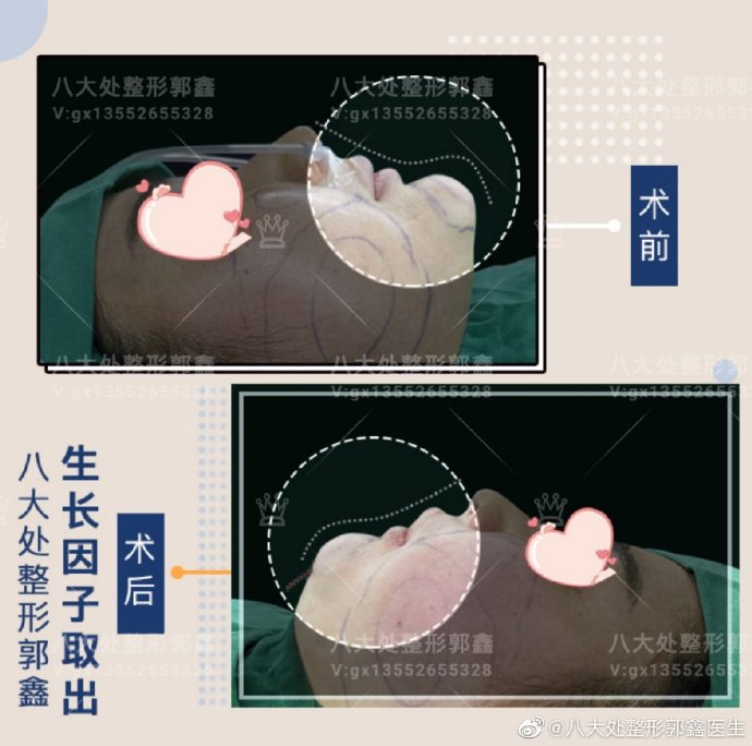 郭鑫取生長因子案例