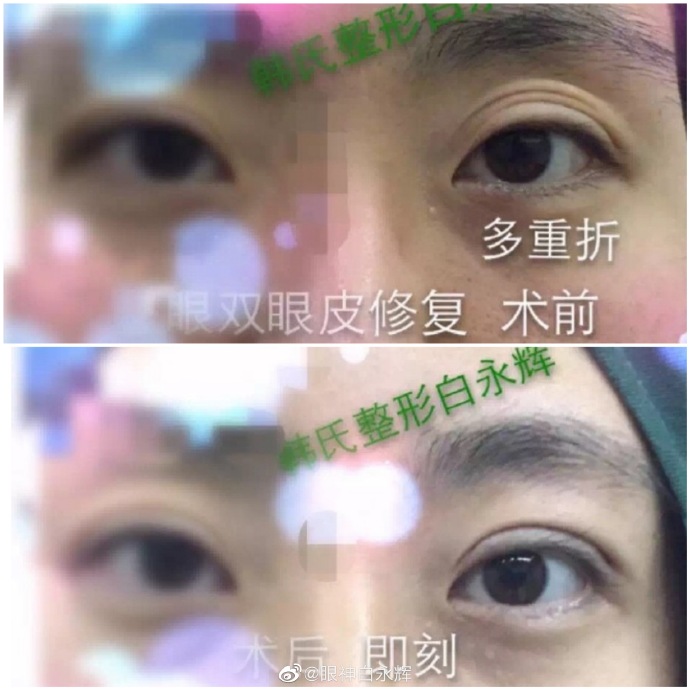 白永輝雙眼皮修復案例