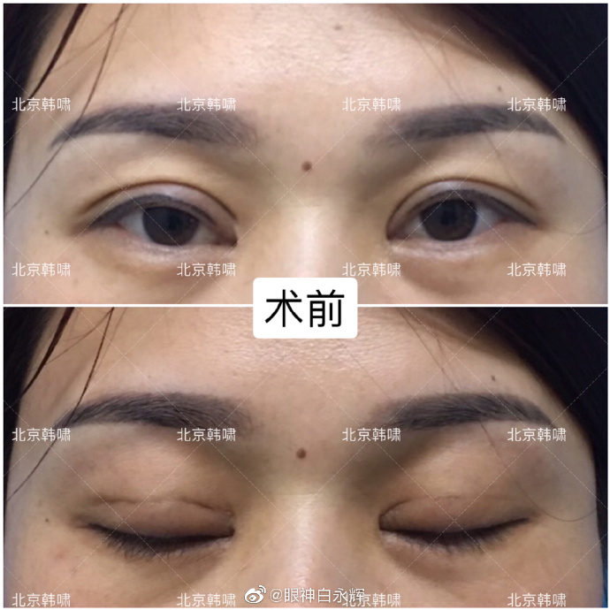 白永輝雙眼皮修復案例