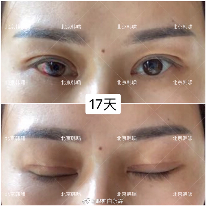 白永輝雙眼皮修復案例