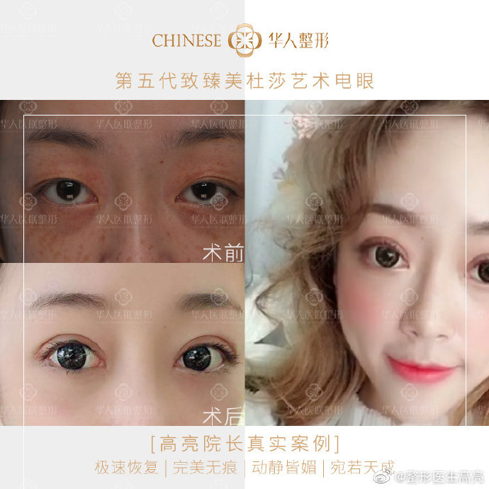 高亮雙眼皮修復案例