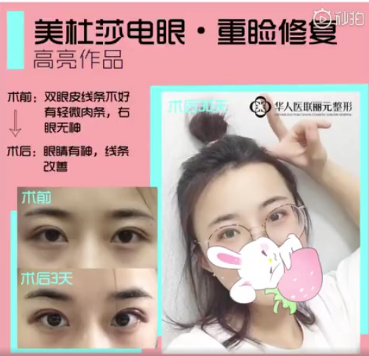 高亮雙眼皮修復案例