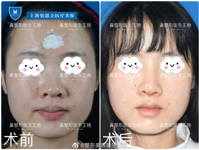 王艷全肋鼻綜合案例