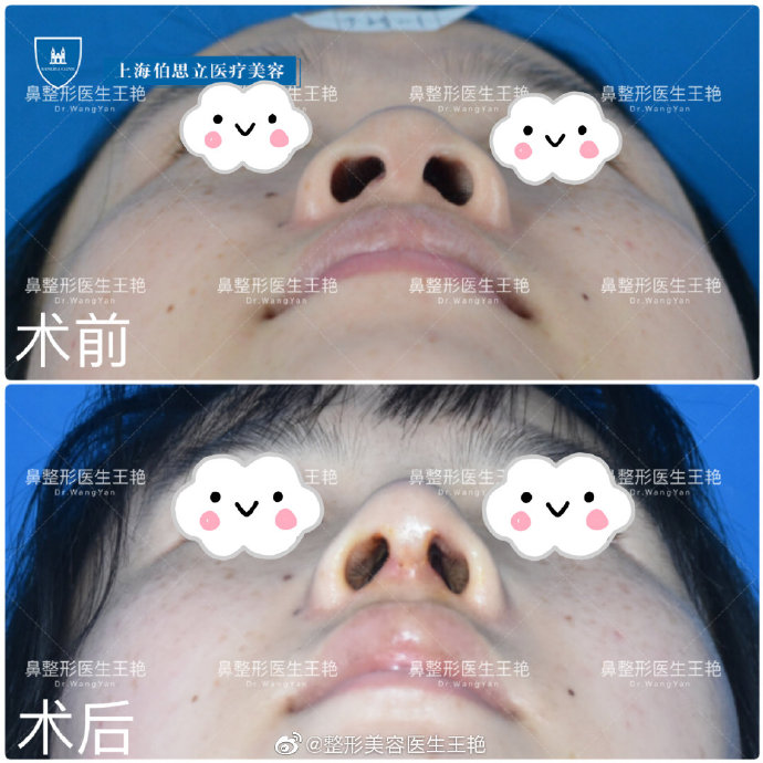 王艷全肋鼻綜合案例
