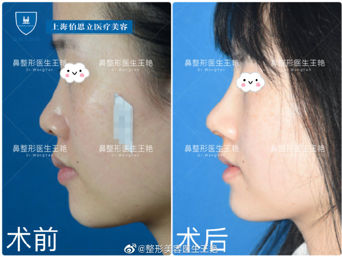 王艷全肋鼻綜合案例
