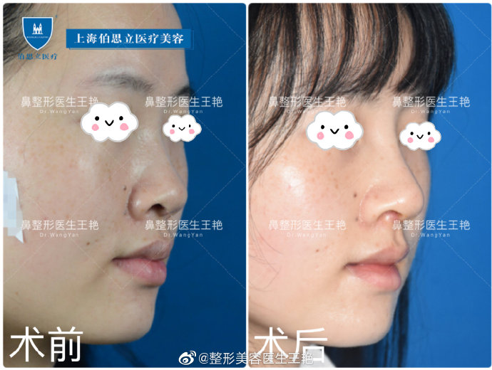 王艷全肋鼻綜合案例