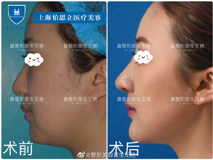 王艷鼻中隔綜合案例
